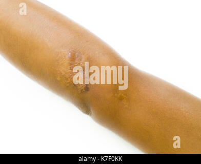 Closeup cheloide cicatrice sul gomito di uomo asiatico pelle dopo incidente in moto su sfondo bianco con copia spazio. Foto Stock