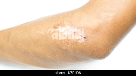 Closeup cheloide cicatrice sul gomito di uomo asiatico pelle dopo incidente in moto su sfondo bianco con copia spazio. Foto Stock