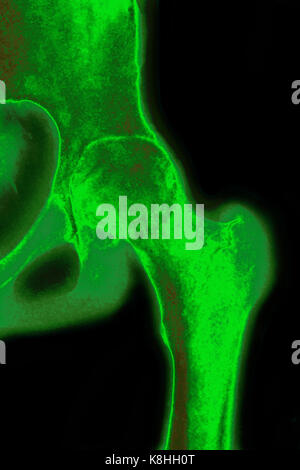 Hip osteoartrite, x-ray Foto Stock