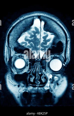 Atrofia cerebrale, MRI Foto Stock