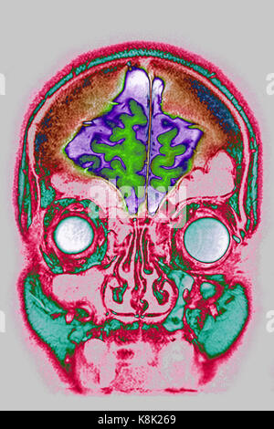 Atrofia cerebrale, MRI Foto Stock