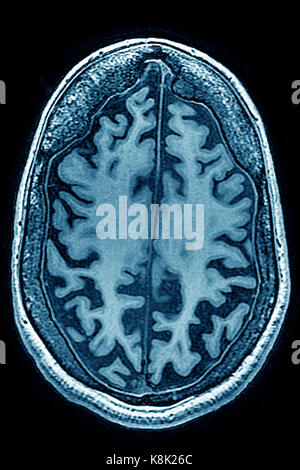 Atrofia cerebrale, MRI Foto Stock