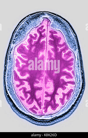 Atrofia cerebrale, MRI Foto Stock