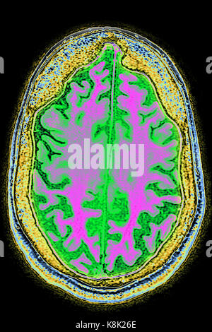 Atrofia cerebrale, MRI Foto Stock