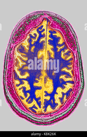 Atrofia cerebrale, MRI Foto Stock