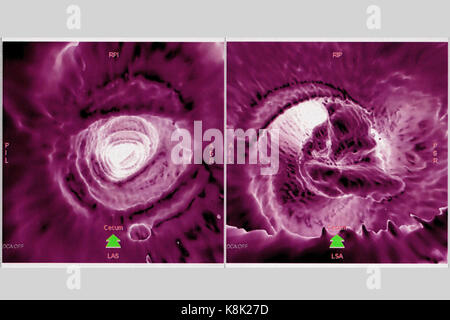 Il cancro del colon CT scan Foto Stock