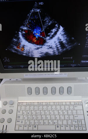 Duc Tam heart hospital. ecocardiogramma doppler. Ho chi minh city. Vietnam. Foto Stock