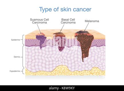 Lo strato di pelle hanno 3 tipo di cancro in uno. Illustrazione Vettoriale