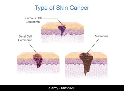 Tipo di cancro della pelle nel vettore 3d stile. Illustrazione Vettoriale