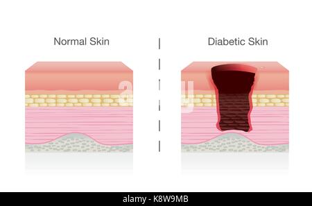 Confrontare la differenza tra la pelle normale e per diabetici le condizioni della pelle. Illustrazione Vettoriale