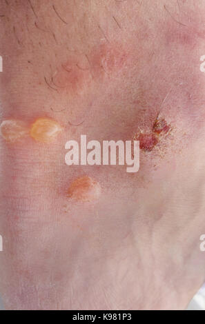 Vista dettagliata del uomo caucasico pelle con alveoli Foto Stock