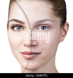 Giovane donna con acne prima e dopo il trattamento. Foto Stock