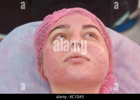 La faccia della giovane donna, acne. Foto Stock