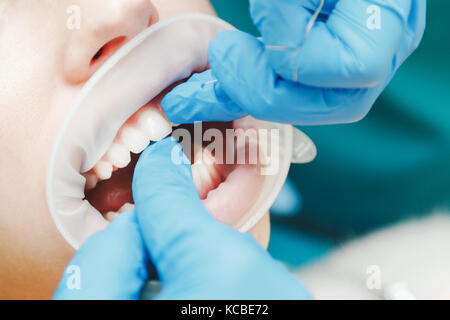 In prossimità della bocca di femmina con avvolgitore. medico filo interdentale i denti. Foto Stock