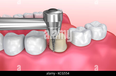 Processo di installazione della corona dentale, illustrazione 3d accurata dal punto di vista medico Foto Stock