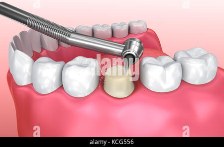 Processo di installazione della corona dentale, illustrazione 3d accurata dal punto di vista medico Foto Stock