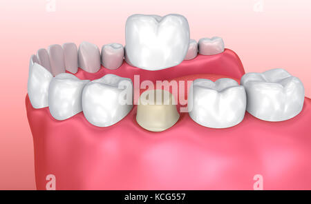 Processo di installazione della corona dentale, illustrazione 3d accurata dal punto di vista medico Foto Stock