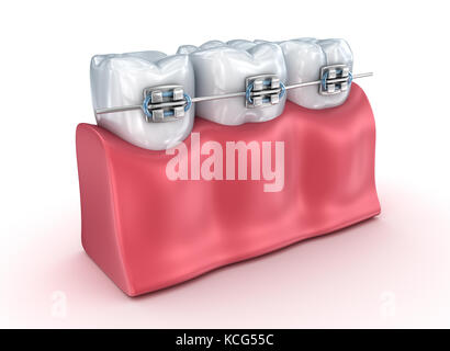 Processo di allineamento dei denti con rinforzi. Illustrazione 3d accurata dal punto di vista medico Foto Stock