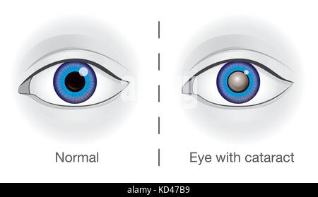 Occhio normale e la lente offuscato da cataratta. Illustrazione Vettoriale