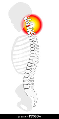 Dolore al collo - spinale ernia del disco o il prolasso a un essere umano delle vertebre cervicali - vista di profilo. illustrazione su sfondo bianco. Foto Stock
