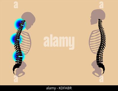 Problemi di schiena, dolori al collo, scivolato prolasso discale - curvate indietro con dolore grave e schiena sana in confronto - illustrazione su sfondo nero. Foto Stock