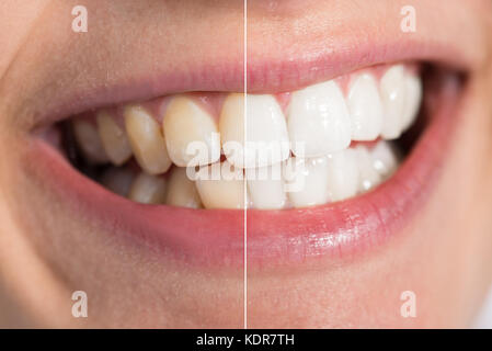 Close-up dettaglio della persona che mostra i denti prima e dopo sbiancamento Foto Stock