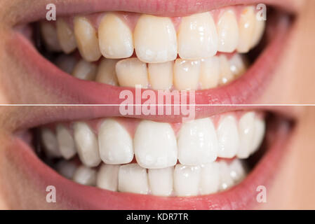 Close-up dettaglio della persona che mostra i denti prima e dopo sbiancamento Foto Stock