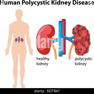 Diagramma che mostra umana della malattia del rene policistico illustrazione Illustrazione Vettoriale