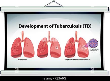 Grafico che mostra lo sviluppo della tubercolosi illustrazione Illustrazione Vettoriale