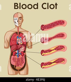 Diagramma che mostra di coagulo di sangue nella figura umana Illustrazione Vettoriale