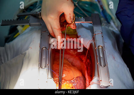 Cuore umano durante gli interventi di cardiochirurgia trapianto. Vista chirurgo torace durante la chirurgia cardiaca Foto Stock