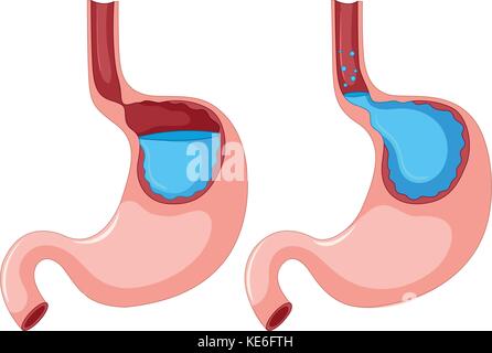 Schema della malattia da reflusso gastroesofageo illustrazione Illustrazione Vettoriale