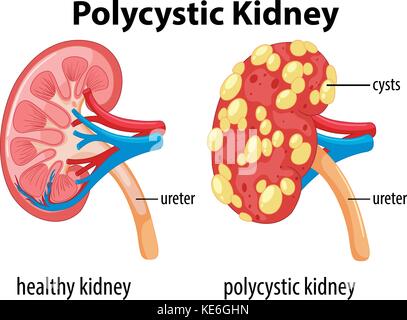 Diagramma che mostra renale policistica illustrazione Illustrazione Vettoriale