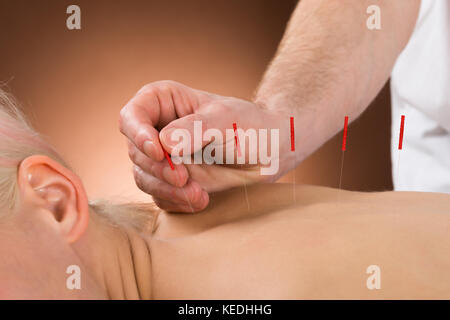 Close-up di una giovane persona che riceve un trattamento di agopuntura in un centro di bellezza e benessere Foto Stock