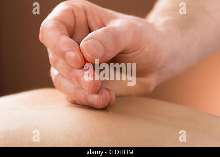 Close-up di una giovane persona che riceve un trattamento di agopuntura in un centro di bellezza e benessere Foto Stock