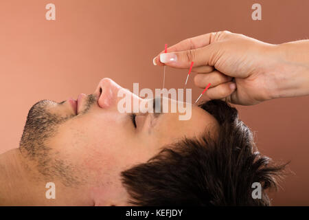 Close-up di un uomo riceve un trattamento di agopuntura in Beauty Spa Foto Stock