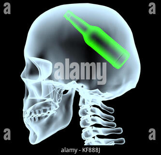 Raggi X di una testa con bottiglia di birra invece del cervello, illustrazione 3d Foto Stock