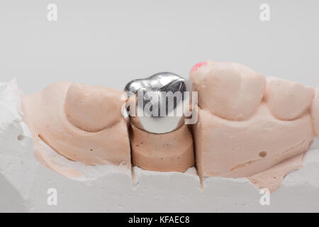 Artificiale di acciaio la corona dentale per la dentizione restauro Foto Stock