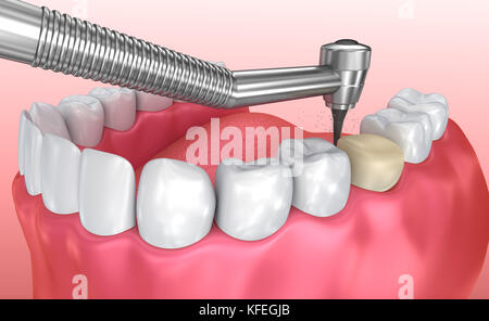 La corona dentale processo di installazione accurata dal punto di vista medico 3d illustrazione Foto Stock