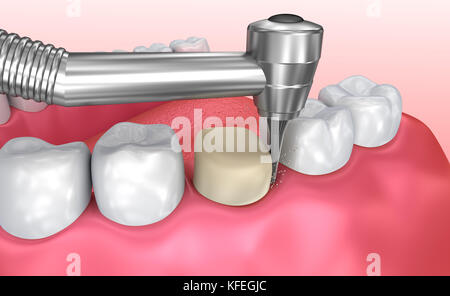 Processo di installazione della corona dentale, illustrazione 3d accurata dal punto di vista medico Foto Stock