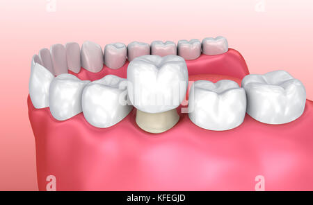 Processo di installazione della corona dentale, illustrazione 3d accurata dal punto di vista medico Foto Stock