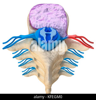 Il midollo spinale sotto pressione di rigonfiamento del disco, 3D illustrazione Foto Stock