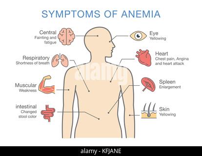 Sintomi comuni a molti tipi di anemia. Illustrazione Vettoriale