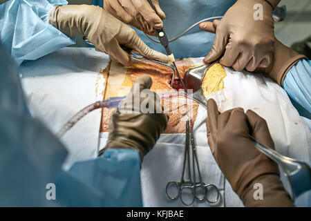 Il chirurgo è utilizzando un bisturi laser in una cavità di un dello stomaco del paziente durante l'operazione addominale. assistenti stanno utilizzando i riavvolgitori chirurgico e medico Foto Stock