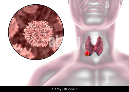 Umano ghiandola tiroide che mostra un tumore e vista ravvicinata di cancro alla tiroide cellule, illustrazione del computer. Foto Stock