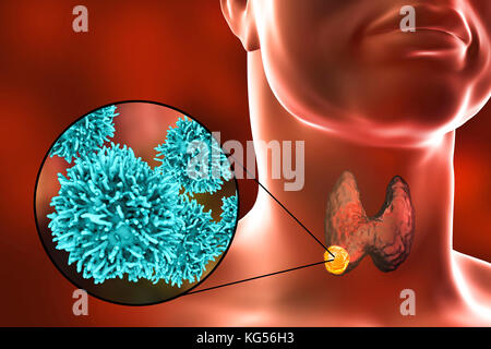 Umano ghiandola tiroide che mostra un tumore e vista ravvicinata di cancro alla tiroide cellule, illustrazione del computer. Foto Stock