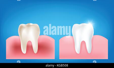 Raccolta di sporco dente e gomma di confrontare con pulito e forte dente bianco con scintillante luce brillante elemento su sfondo blu illutratio vettore Illustrazione Vettoriale