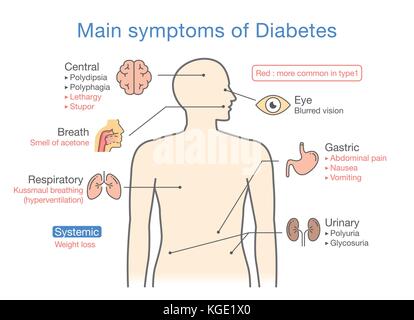 Illustrazione delle principali sintomi del diabete. Illustrazione Vettoriale