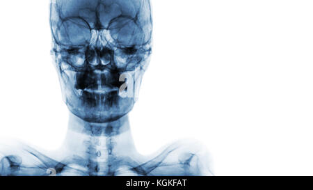 Film x-ray cranio ap : mostra umano normale del cranio e la zona vuota a destra . Foto Stock