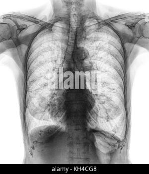Radiografia toracica normale di un paziente anziano . Si può vedere calcificazione a costola , trachea , bronco . Vista frontale . Foto Stock